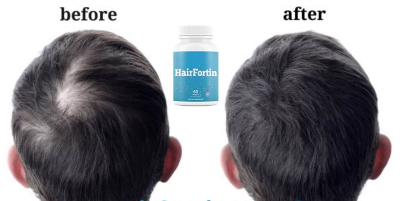 Hairfortin Review - Can This Supplement Help You Stop Hair Loss?